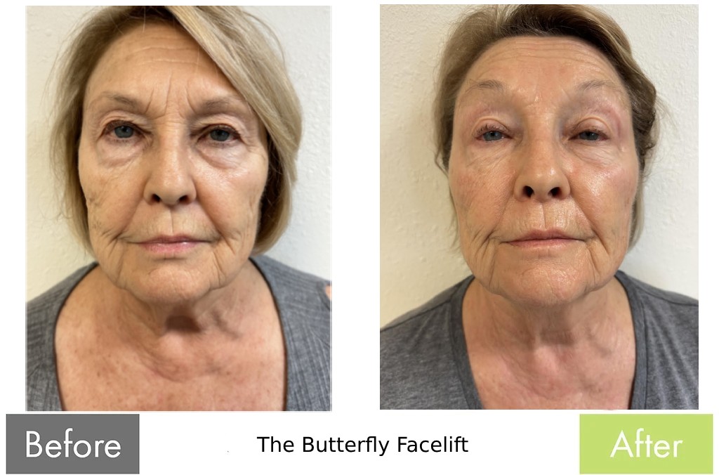 Before and after — Full face & neck rejuvenation