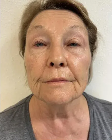 72 Years Old, Never Looked So Good — the Butterfly Facelift — after photo