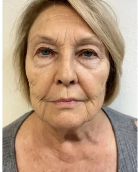 72 Years Old, Never Looked So Good — the Butterfly Facelift — before photo