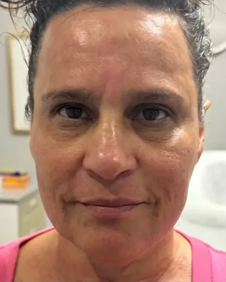 Transformation with Butterfly Facelift — the Butterfly Facelift — after photo