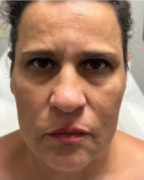 Transformation with Butterfly Facelift — the Butterfly Facelift — before photo