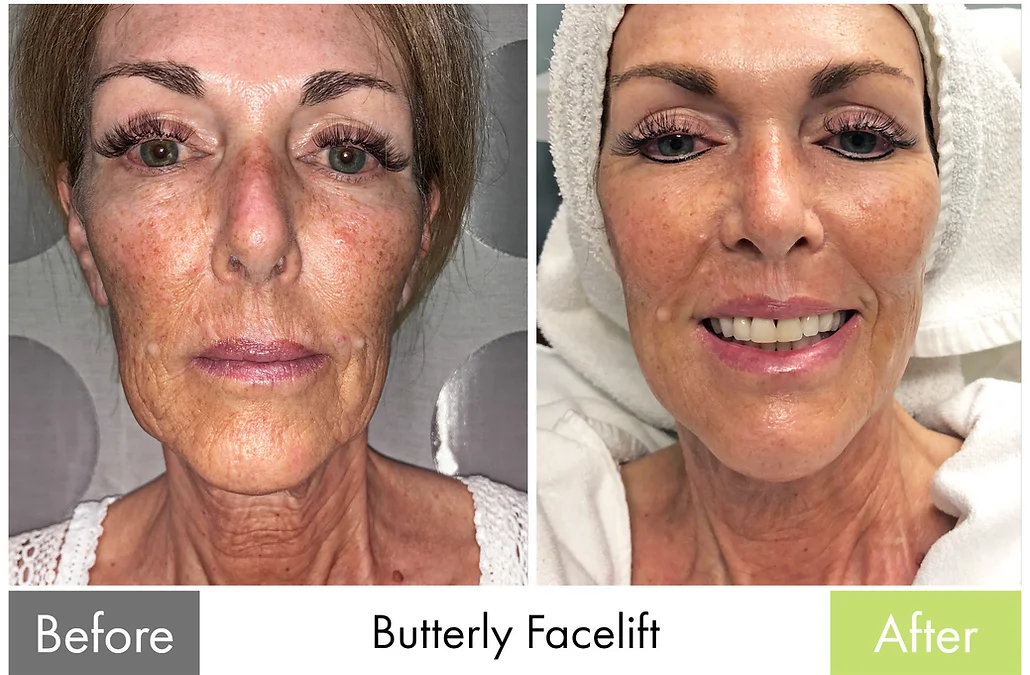 Before and after — Overall skin rejuvenation & firmness