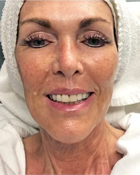 Skin Rejuvenation — the Butterfly Facelift — after photo