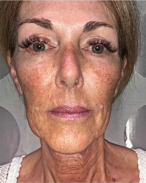 Skin Rejuvenation — the Butterfly Facelift — before photo