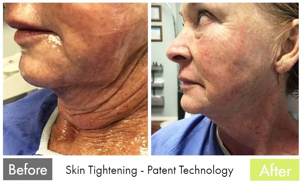 Neck Rejuvenation — before and after the Butterfly Facelift