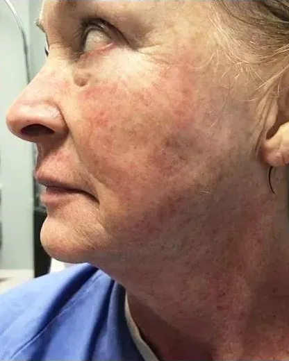 Neck Rejuvenation — the Butterfly Facelift — after photo
