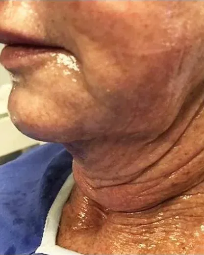 Neck Rejuvenation — the Butterfly Facelift — before photo
