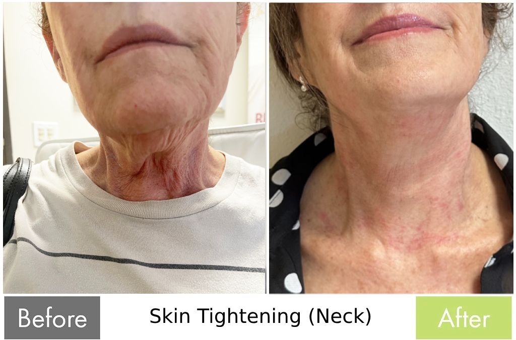 Skin Tightening (Neck) — before and after the Butterfly Facelift