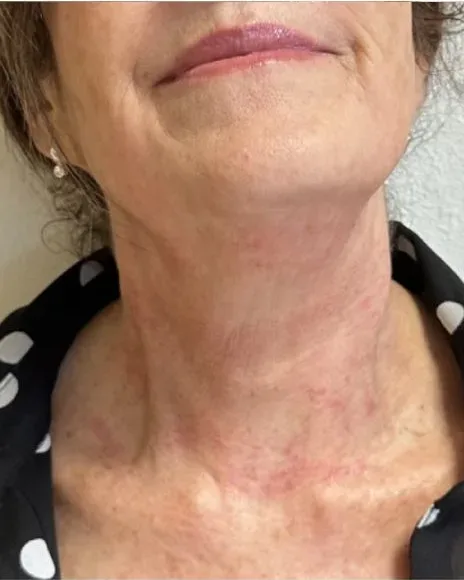 Skin Tightening (Neck) — the Butterfly Facelift — after photo