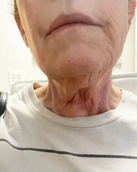 Skin Tightening (Neck) — the Butterfly Facelift — before photo