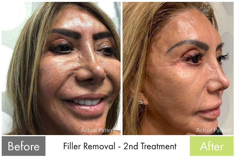 Filler Removal — before and after the Butterfly Facelift