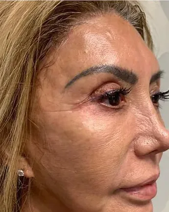 Filler Removal — the Butterfly Facelift — after photo
