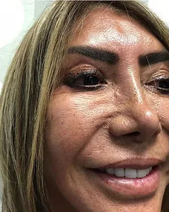 Filler Removal — the Butterfly Facelift — before photo