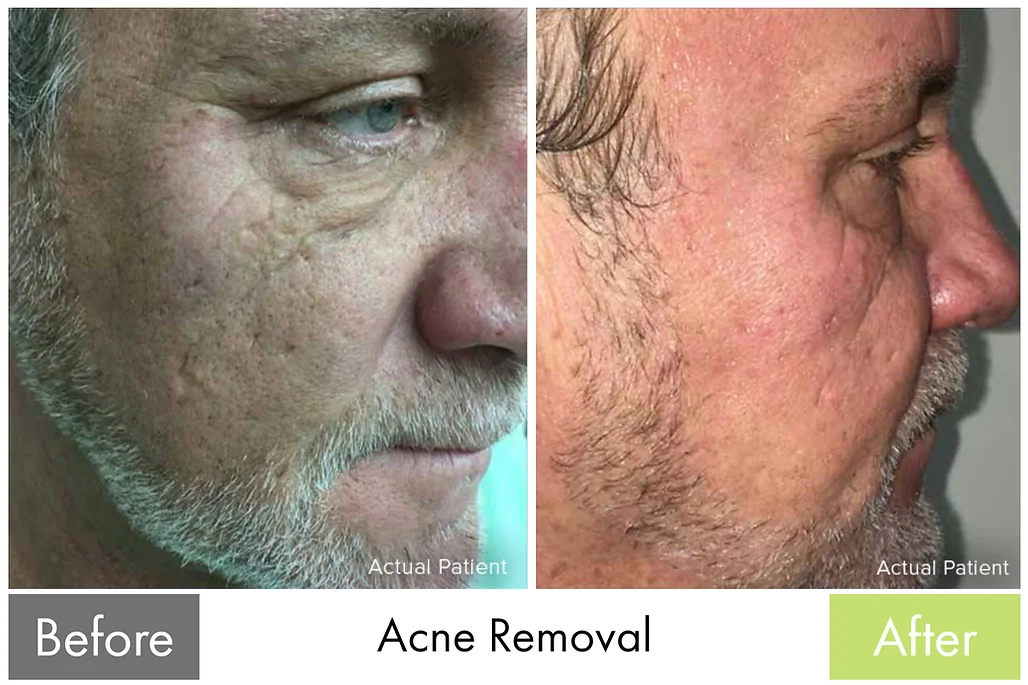 Scar & Acne Removal — before and after the Butterfly Facelift