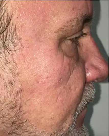 Scar & Acne Removal — the Butterfly Facelift — after photo