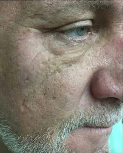 Scar & Acne Removal — the Butterfly Facelift — before photo