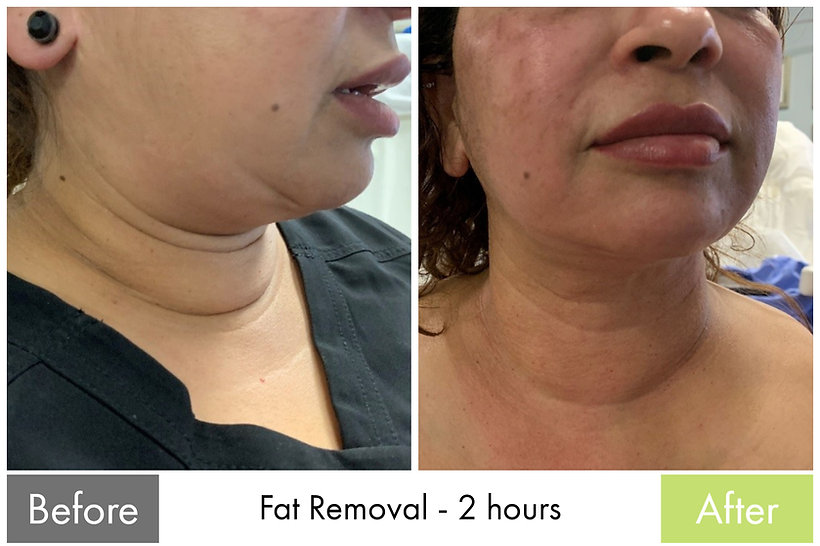 Fat Removal — before and after the Butterfly Facelift