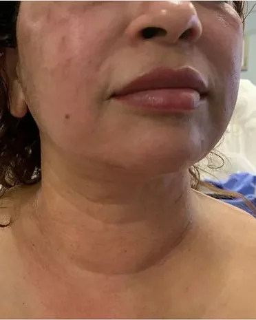 Fat Removal — the Butterfly Facelift — after photo