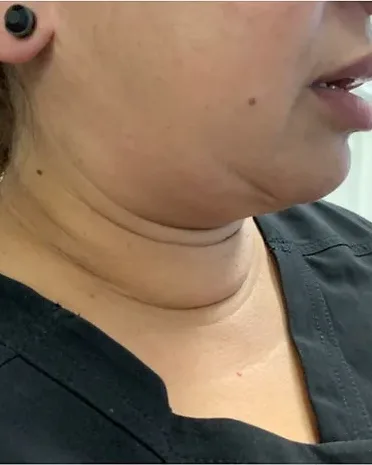 Fat Removal — the Butterfly Facelift — before photo
