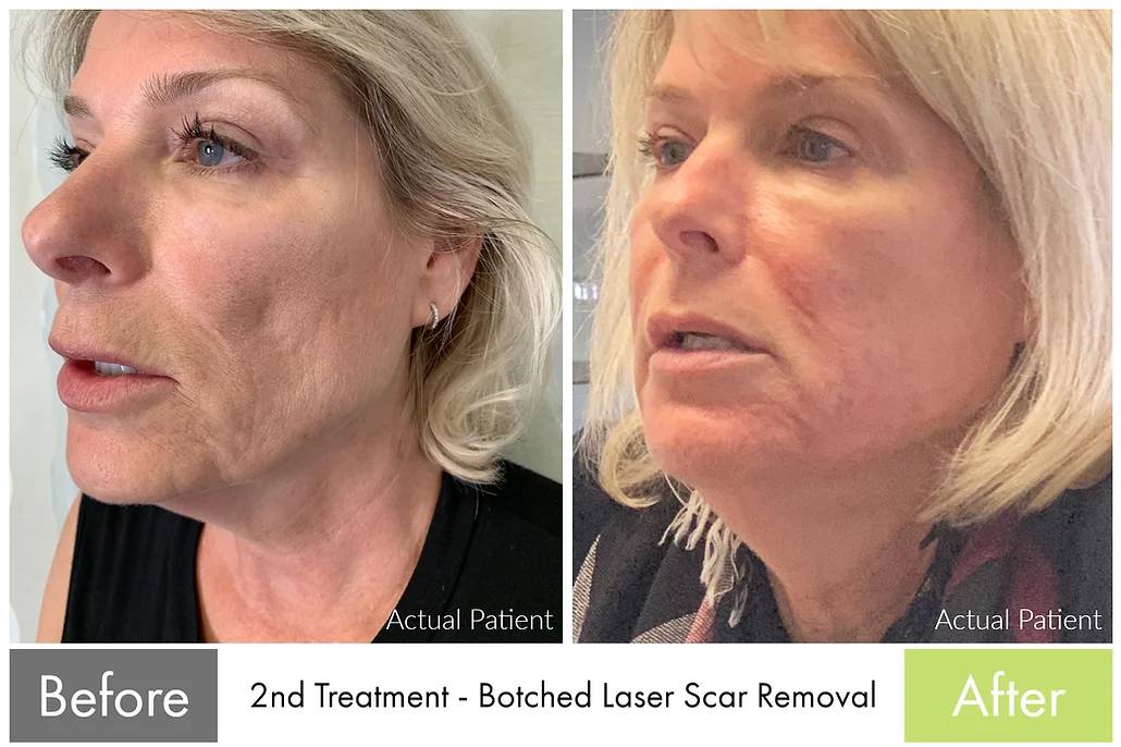 Butterfly Facelift with Ultherapy — before and after the Butterfly Facelift