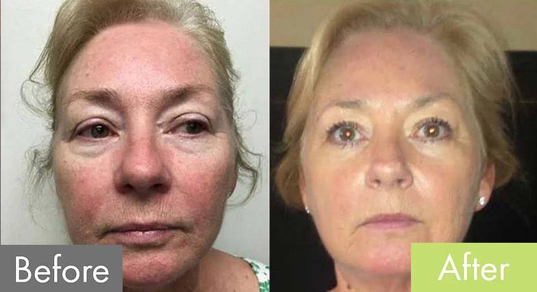 Butterfly Facelift with Ultherapy — before and after the Butterfly Facelift
