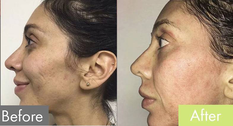 Acne Scar Removal — before and after the Butterfly Facelift