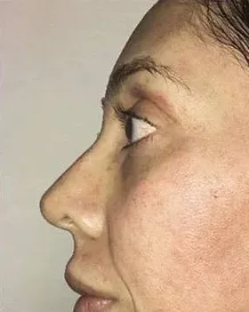 Acne Scar Removal — the Butterfly Facelift — after photo