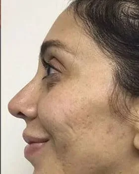 Acne Scar Removal — the Butterfly Facelift — before photo