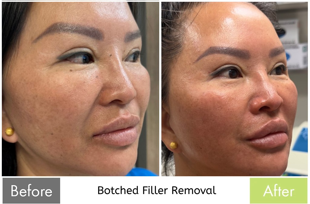 Botched Filler Removal — before and after the Butterfly Facelift