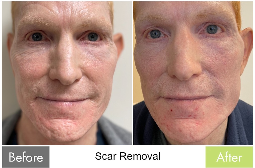 Scar Removal — before and after the Butterfly Facelift