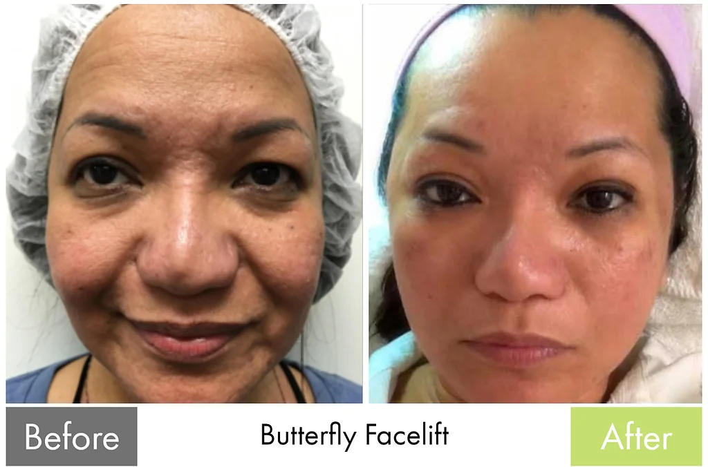 Acne & Texture Rejuvenation — before and after the Butterfly Facelift