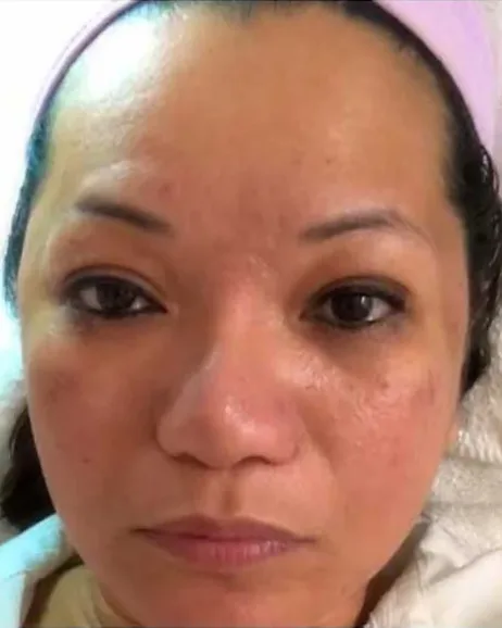 Acne & Texture Rejuvenation — the Butterfly Facelift — after photo