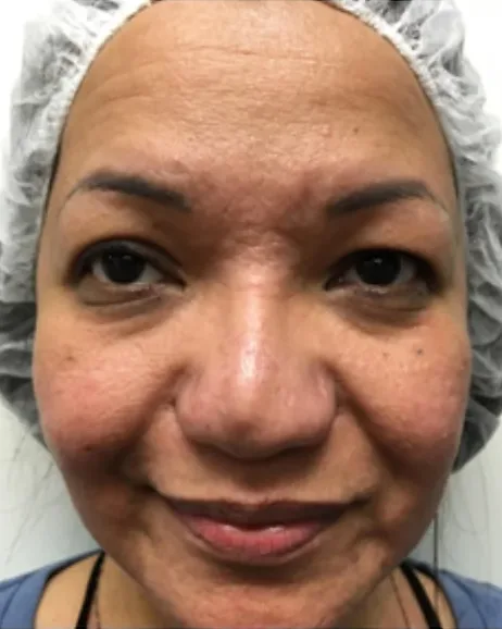 Acne & Texture Rejuvenation — the Butterfly Facelift — before photo