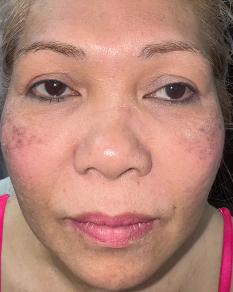 Nose Refinement with a Lifted Eye Appearance — the Butterfly Facelift — after photo