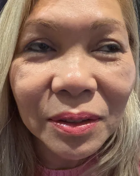 Nose Refinement with a Lifted Eye Appearance — the Butterfly Facelift — before photo