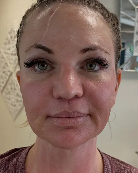 Cheek Scar Softening with Jawline Tightening — the Butterfly Facelift — after photo