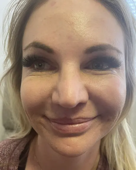Cheek Scar Softening with Jawline Tightening — the Butterfly Facelift — before photo