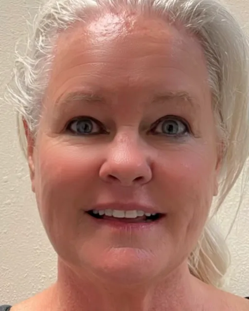 Butterfly Facelift On-Camera Reveal — the Butterfly Facelift — after photo