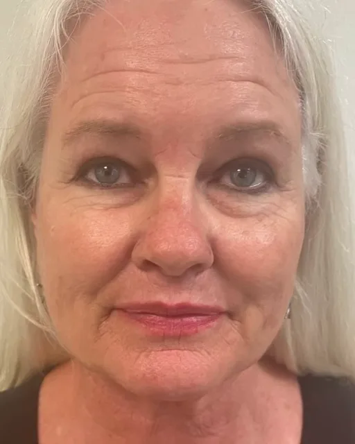 Butterfly Facelift On-Camera Reveal — the Butterfly Facelift — before photo