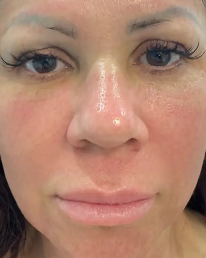 Butterfly Facelift Front-View Results — the Butterfly Facelift — after photo