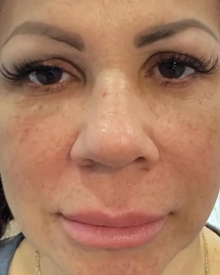 Butterfly Facelift Front-View Results — the Butterfly Facelift — before photo