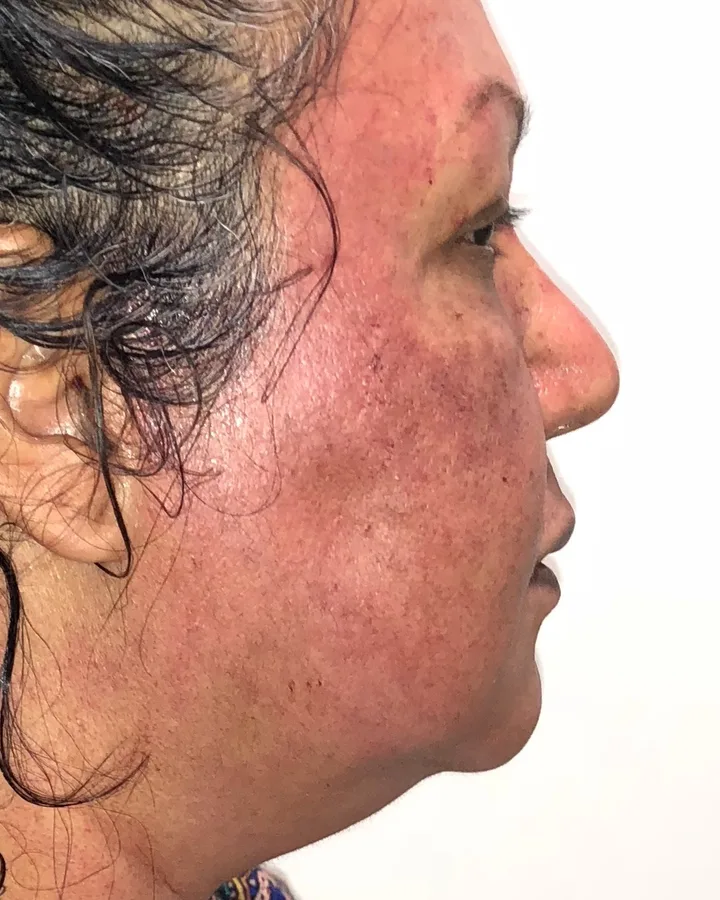 Same-Day Acne Scar Softening — the Butterfly Facelift — after photo