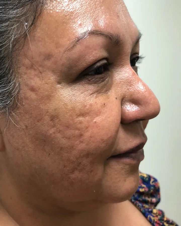 Same-Day Acne Scar Softening — the Butterfly Facelift — before photo