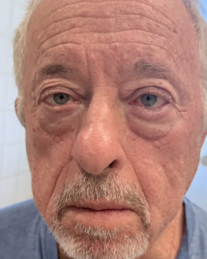 Softening the Look of Under-Eye Bags — the Butterfly Facelift — after photo