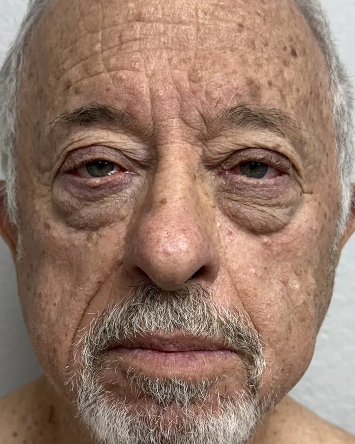 Softening the Look of Under-Eye Bags — the Butterfly Facelift — before photo