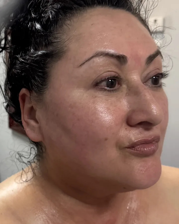 Apollo RF & Ultra Cavitation in 16 Minutes — Apollo TriPollar RF + Ultra Cavitation — after photo