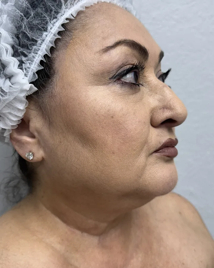 Apollo RF & Ultra Cavitation in 16 Minutes — Apollo TriPollar RF + Ultra Cavitation — before photo