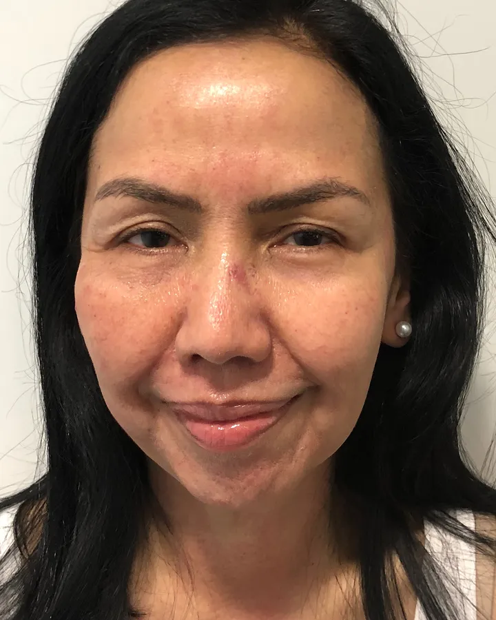 Apollo RF & Ultra Cavitation Facial Refresh — Apollo TriPollar® RF + Ultra Cavitation — after photo