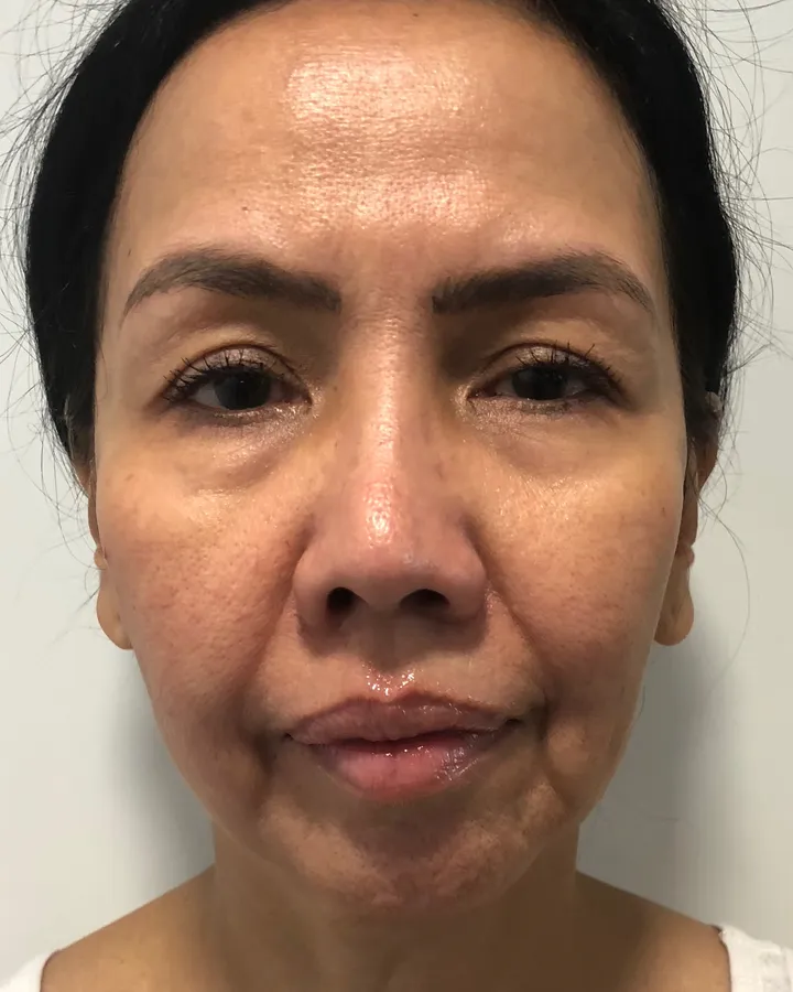 Apollo RF & Ultra Cavitation Facial Refresh — Apollo TriPollar® RF + Ultra Cavitation — before photo