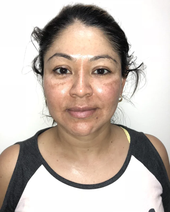 Microneedling Face & Neck Refresh — Microneedling — after photo